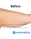 Coolsculpting Treatment