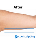 Coolsculpting Treatment