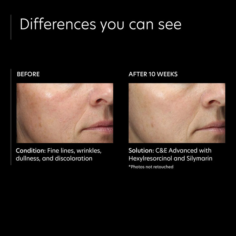 PCA C&E Advanced with Hexylresorcinol