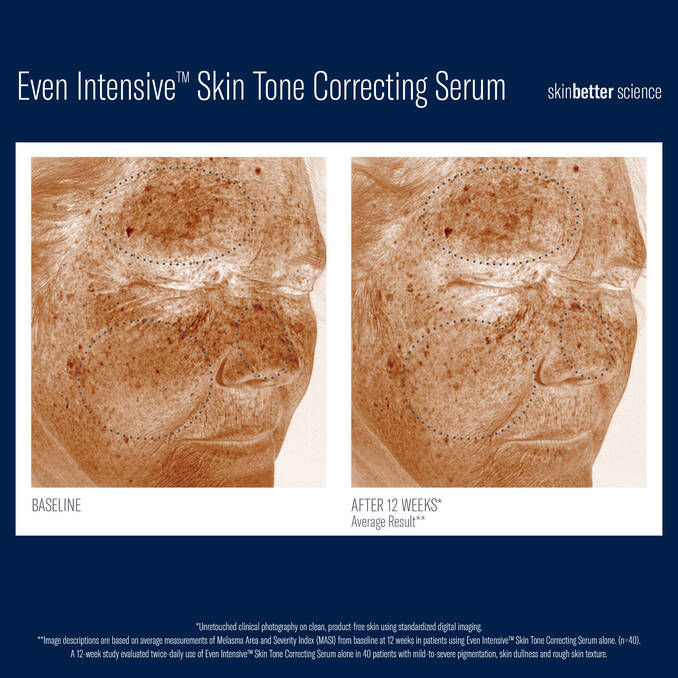 Before and after 12 week comparison UV photos of using SkinBetter Science Even Intensive Skin Tone Correcting Serum on Fair Skin with Melasma and Pigmentation