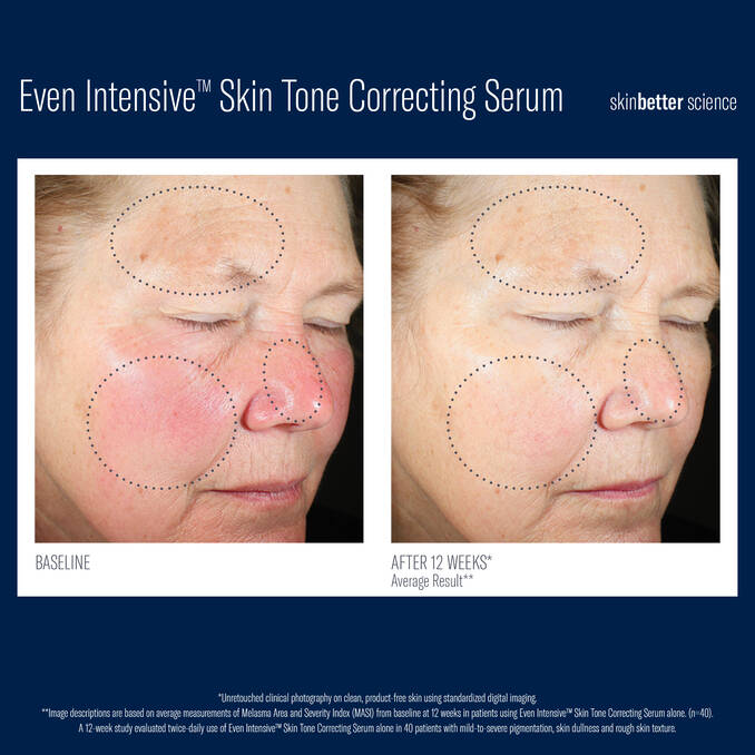 Before and after 12 week comparison photos of using SkinBetter Science Even Intensive Skin Tone Correcting Serum on Fair Skin with Melasma and Pigmentation