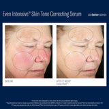 Before and after 12 week comparison photos of using SkinBetter Science Even Intensive Skin Tone Correcting Serum on Fair Skin with Melasma and Pigmentation