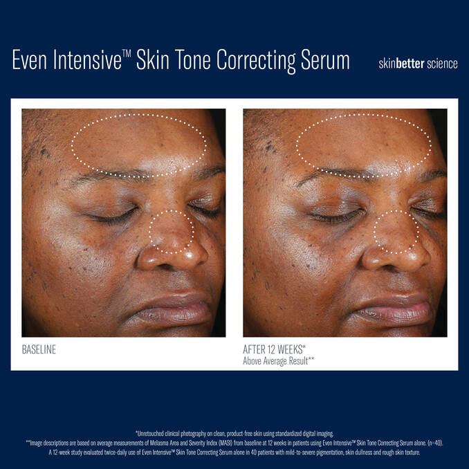 Before and after 12 week comparison photos of using SkinBetter Science Even Intensive Skin Tone Correcting Serum on Dark Skin with Melasma and Pigmentation