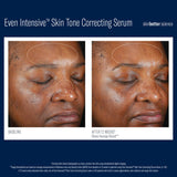 Before and after 12 week comparison photos of using SkinBetter Science Even Intensive Skin Tone Correcting Serum on Dark Skin with Melasma and Pigmentation