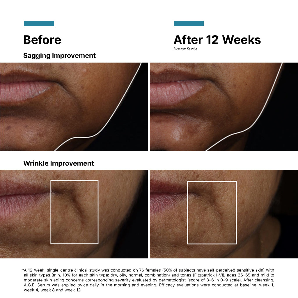 Before and after comparison for 12 weeks of use of the SkinCeuticals A.G.E. Interrupter Ultra Serum highlighting sagging and wrinkle improvement on skin.