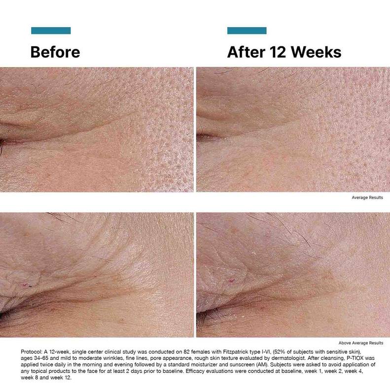 Before and after comparison showing visible reduction in fine lines and expression wrinkles on the face after using SkinCeuticals P-TIOX serum, highlighting smoother, more radiant skin