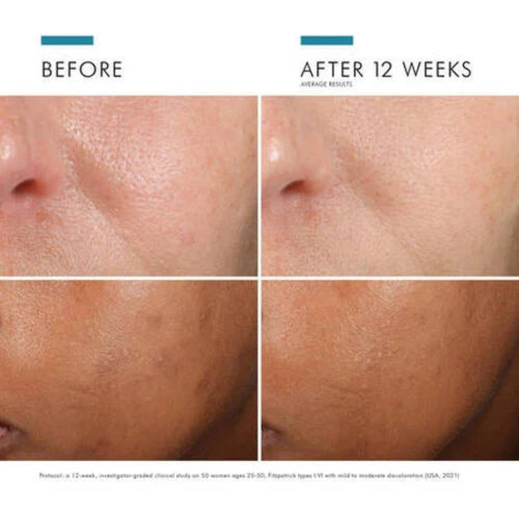 Before and after photo showing 12-week results of SkinCeuticals Phloretin CF—visible improvement in skin tone, texture, and discoloration reduction
