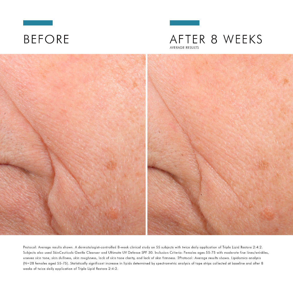 Before and after results of using SkinCeuticals Triple Lipid Restore 2:4:2 showing improved skin smoothness and radiance