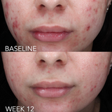 Before and after image of a woman using ZO® Acne Complex, showing visible improvement from baseline to week 12, with reduced acne breakouts, smoother skin texture, and a clearer, more balanced complexion