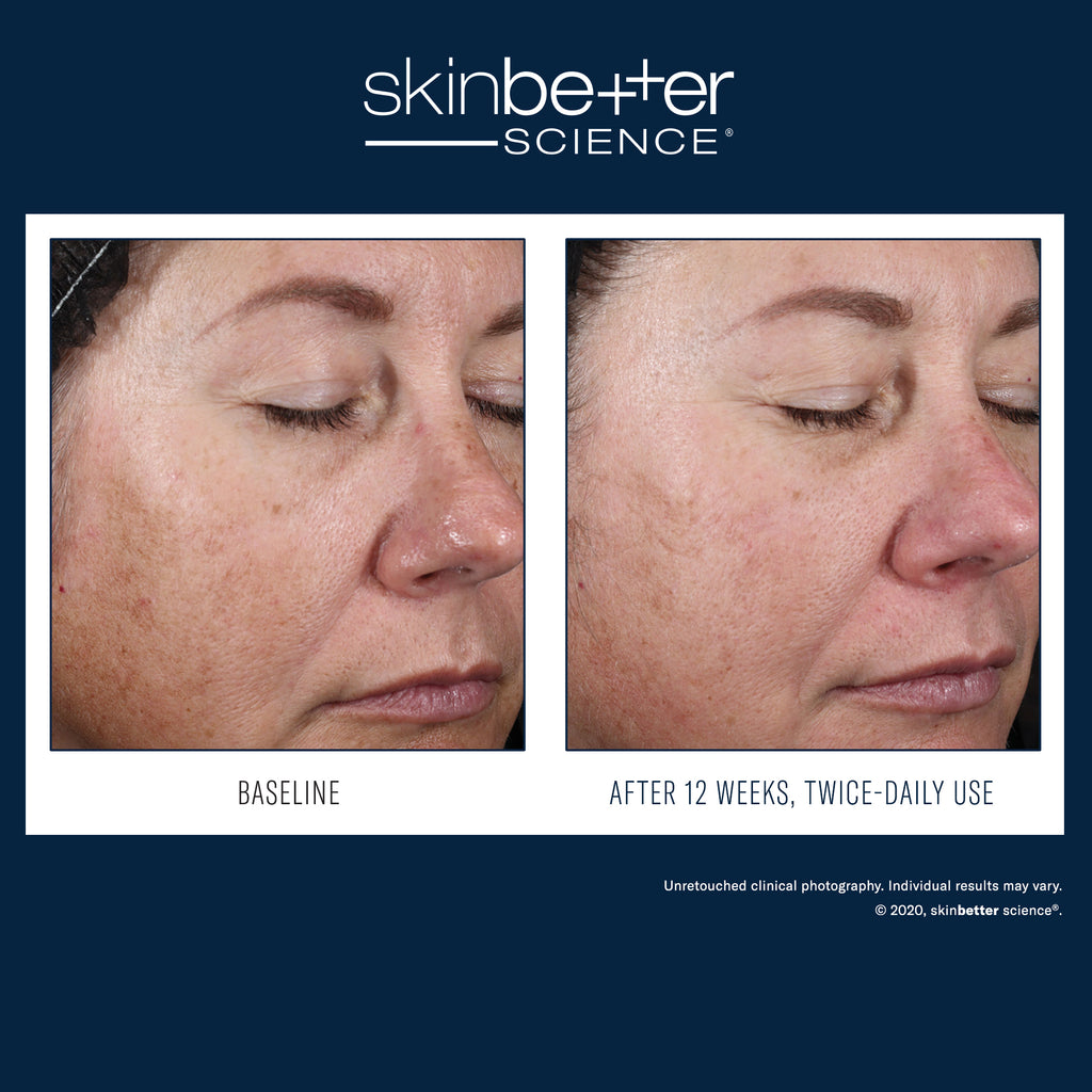 Before and after 2 weeks of using Skinbetter Science AlphaRet Night Cream, showing visible improvement in fine lines, smoother skin texture, reduced discoloration, and enhanced radiance