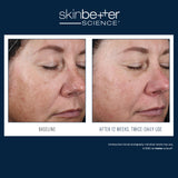 Before and after 2 weeks of using Skinbetter Science AlphaRet Night Cream, showing visible improvement in fine lines, smoother skin texture, reduced discoloration, and enhanced radiance