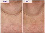Before and after comparison of skin texture on a neck area.