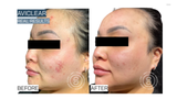 Before and after comparison of a person's face with visible acne treatment results using Aviclear.