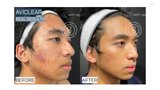 Before and after comparison of a person's face with Aviclear treatment, showing acne skin improvement.