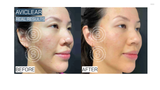 Before and after comparison of a acne laser treatment with AviClear.