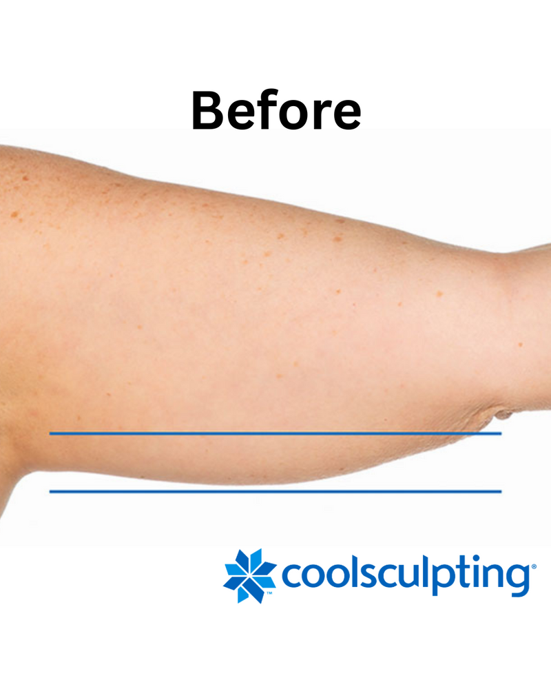 Coolsculpting Treatment
