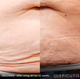 Before and After photos of the abdomen area after using the Epicutis Lipid Body Treatment for 12weeks