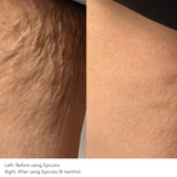 Before and After photos of the inner thigh after using the Epicutis Lipid Body Treatment for 8 months