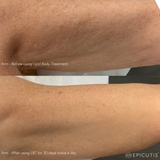 Before and After photos of the upper arm after using the Epicutis Lipid Body Treatment for 30 days