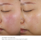Before and after eight weeks of EPICUTIS skincare use showing visibly reduced redness, calmer skin, and improved overall tone and clarity on sensitive cheek area