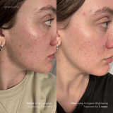 Before and after two weeks of EPICUTIS Arctigenin Brightening Treatment showing clearer-looking skin, reduced visible redness, and improved tone and texture across acne-prone cheek and jawline areas