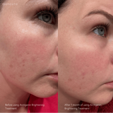Before and after one month results of EPICUTIS Arctigenin Brightening Treatment showing visibly brighter skin tone, improved clarity, and reduced redness and uneven texture on the cheek area