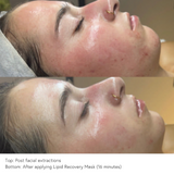 Before and after EPICUTIS Lipid Recovery Mask following facial extractions showing visibly reduced redness, calmer skin, and soothed post-treatment irritation after 16 minutes