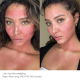 Before and after EPICUTIS Lipid Recovery Mask post-microneedling showing visibly reduced facial and chest redness, calmer skin, and soothed post-treatment irritation in 10 minutes
