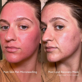 Before and after EPICUTIS Lipid Recovery Mask following SkinPen microneedling showing visibly reduced redness, calmer skin, and soothed post-procedure irritation after 30 minutes