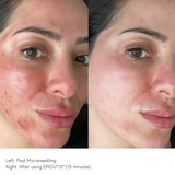 Before and after EPICUTIS Lipid Recovery Mask following microneedling showing visibly calmer skin, reduced redness, and soothed post-procedure irritation in just 15 minutes
