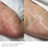 Before and after EPICUTIS Lipid Recovery Mask use on sunburned skin showing visibly reduced redness, soothed irritation, and calmer, more hydrated skin appearance