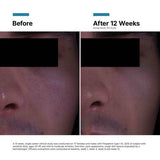 Before and after 12 week study, large pores reduced, skin is smoother. Results may vary.