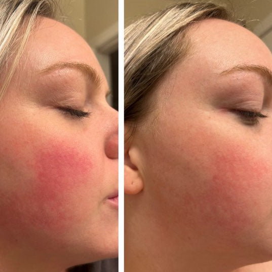 Before and after results of Clarity II laser treatment for rosacea on a woman's face – visible reduction in redness and improved skin clarity.