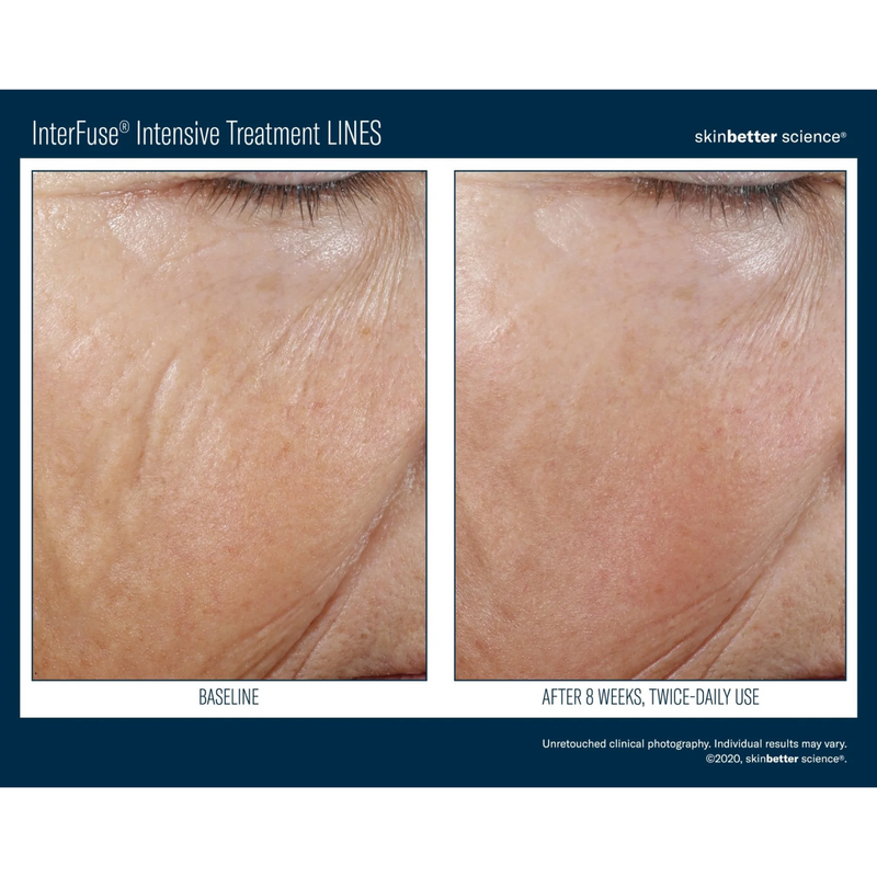 Alastin TransFORM Body Treatment – Anti-Aging Vancouver