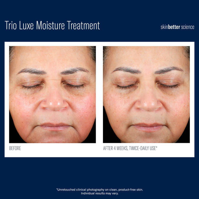 Before and after comparison of a woman’s face using SkinBetter Science Trio Luxe Moisture Treatment twice daily for 4 weeks, showing visible improvement in skin hydration, redness reduction, and smoother texture. Unretouched clinical photography