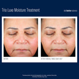Before and after comparison of a woman’s face using SkinBetter Science Trio Luxe Moisture Treatment twice daily for 4 weeks, showing visible improvement in skin hydration, redness reduction, and smoother texture. Unretouched clinical photography