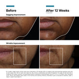 Before and after comparison for 12 weeks of use of the SkinCeuticals A.G.E. Interrupter Ultra Serum highlighting sagging and wrinkle improvement on skin.